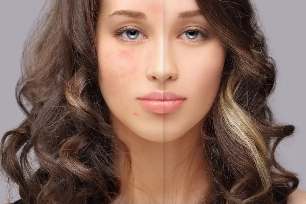 Why Does My Fungal Acne Keep Coming Back?