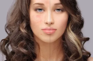 Why Does My Fungal Acne Keep Coming Back?