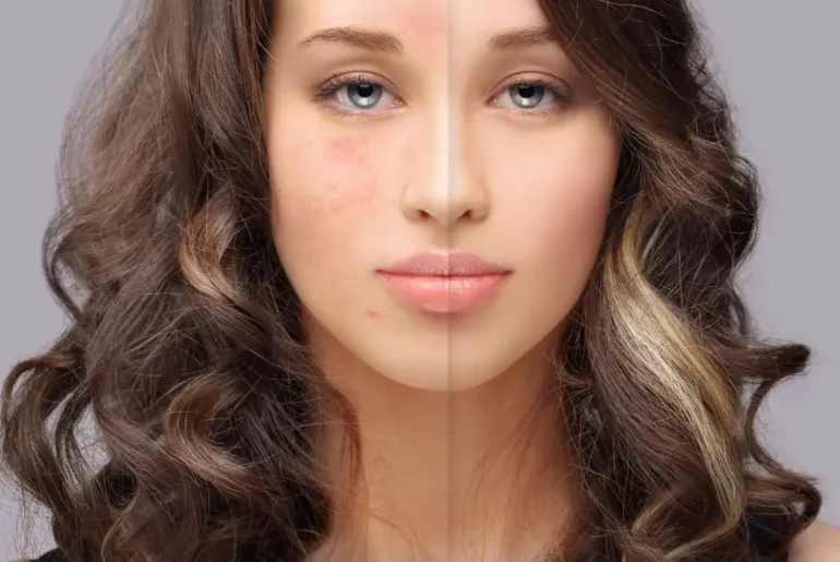 Why Does My Fungal Acne Keep Coming Back?