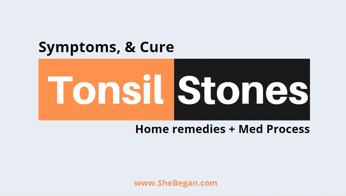 Tonsil Stones Symptoms of Tonsil Stones, Home Remedies and Medical Procedures to get rid of Tonsil Stones