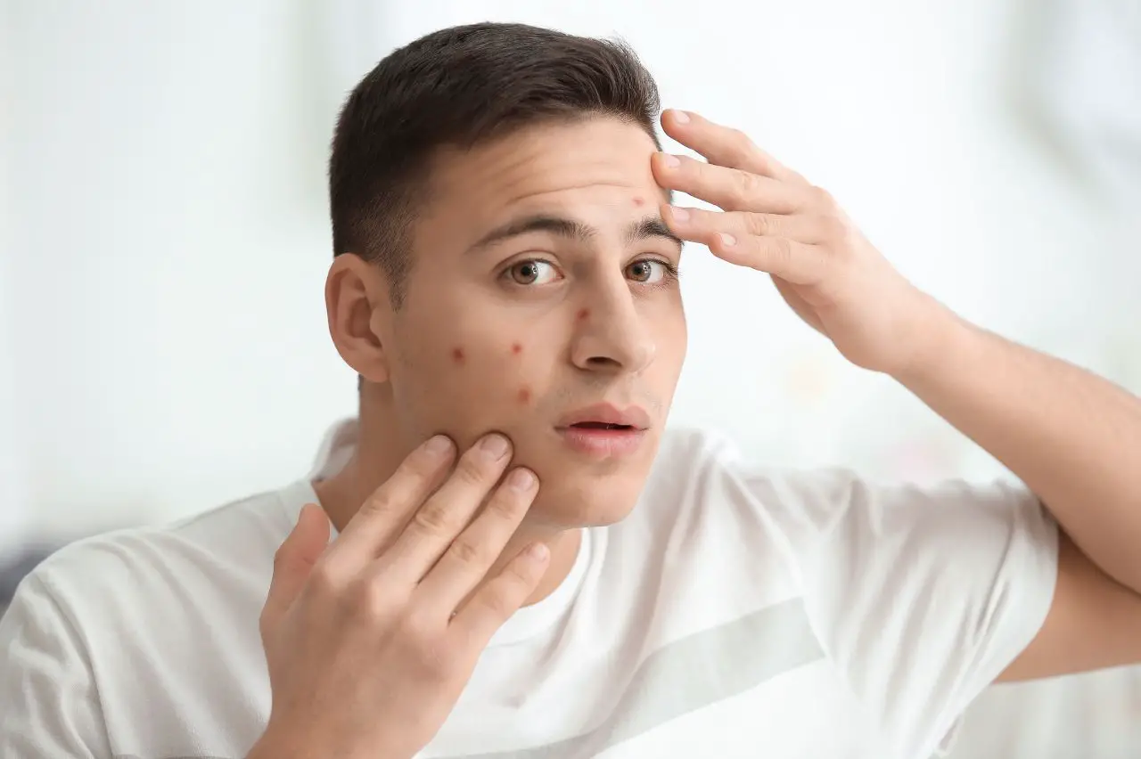 Can Guys Wear Makeup To Cover Up Acne?
