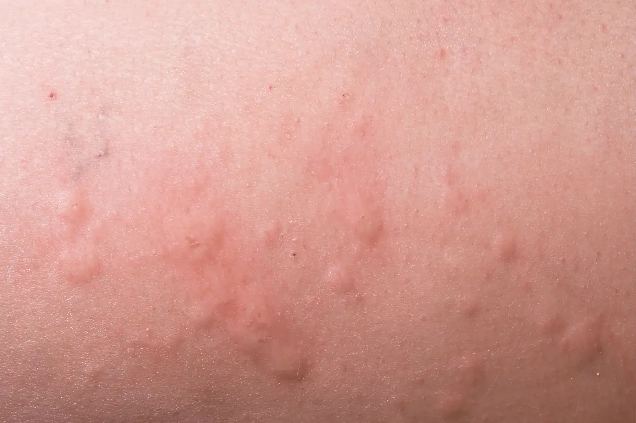 Causes of Hives From a Tanning Bed