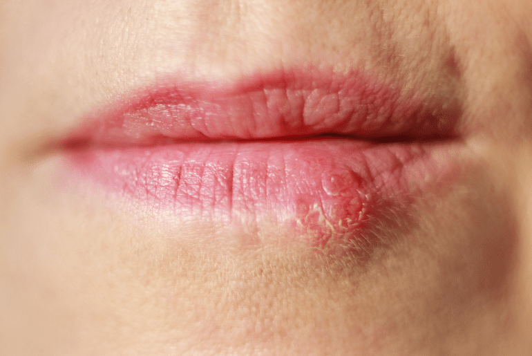 you can get cold sores from using an infected lip gloss