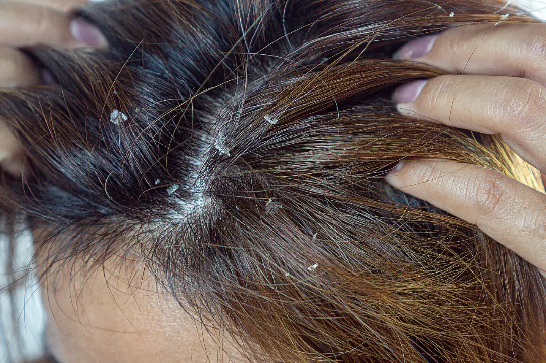 What Is The White Stuff In Hair After Washing?