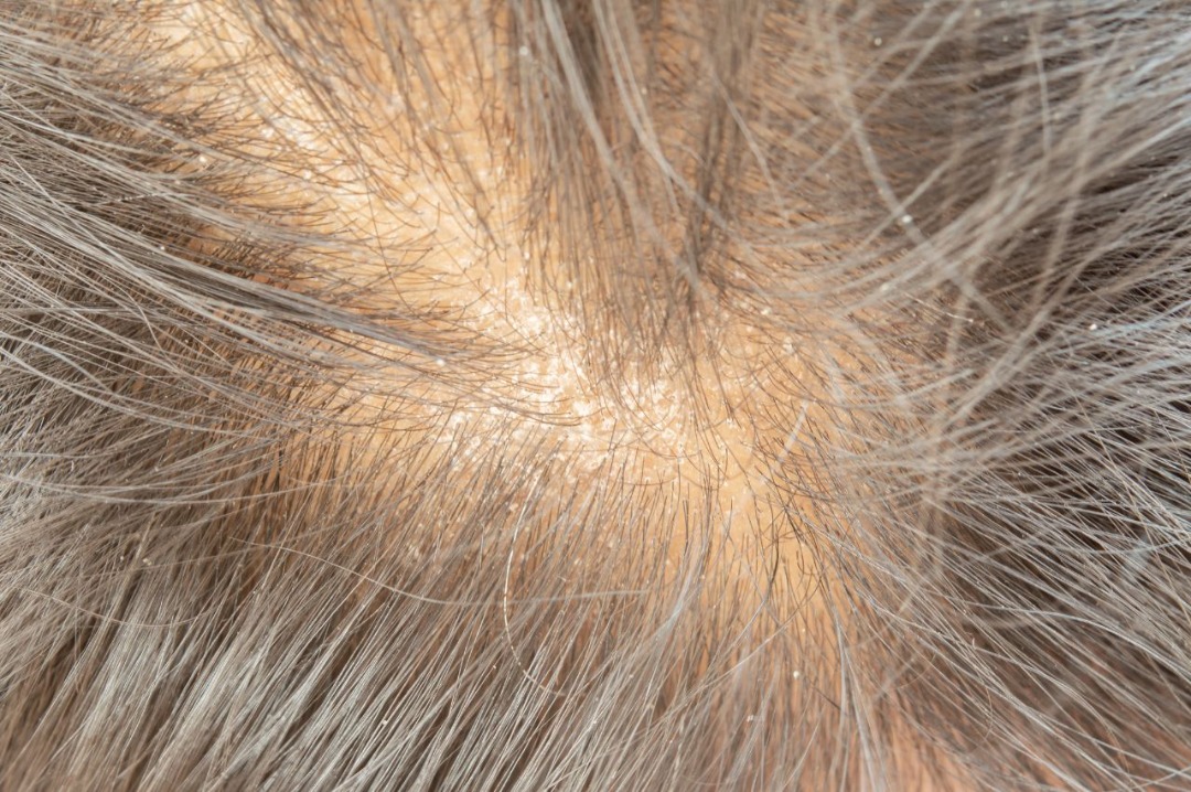 Dry hair scalp