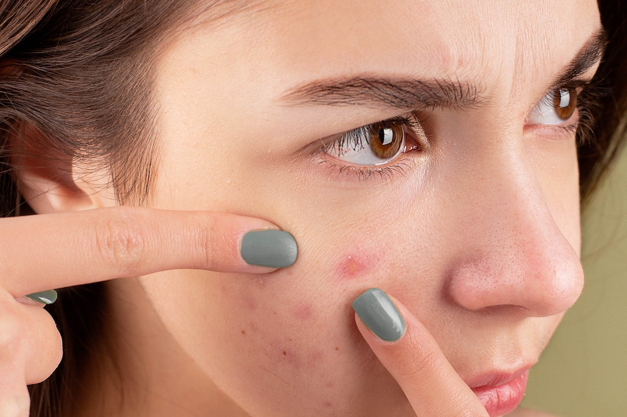 Acne face