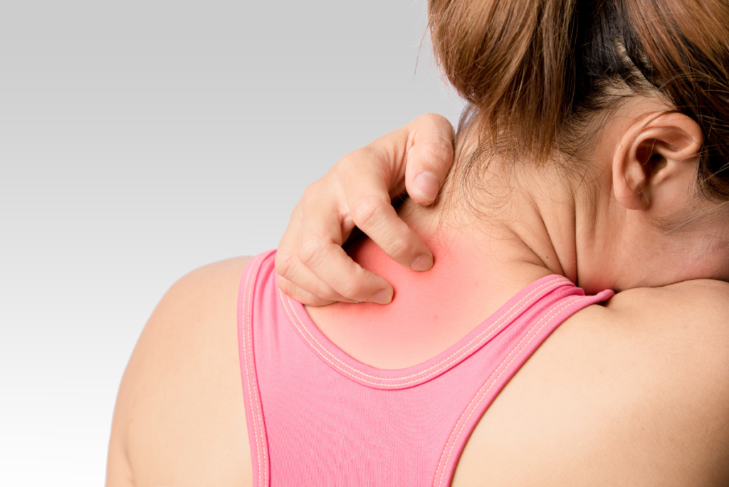 Eczema Flare-Ups