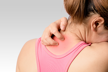 Eczema Flare-Ups