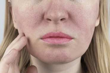 How To Hide Rosacea Without Makeup