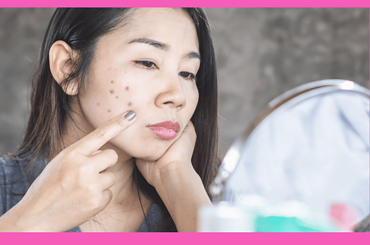 What color of Concealer for Dark Spots