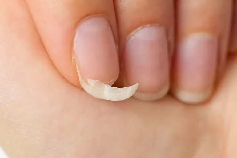 How to fix fingernails that grow upwards