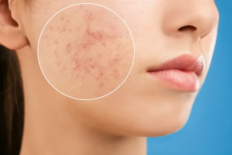Strategies for Managing Hormonal Acne