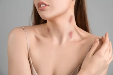 What Does a Love Bite from a Guy Mean