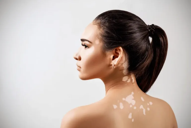 Can Concealer Cover Vitiligo?