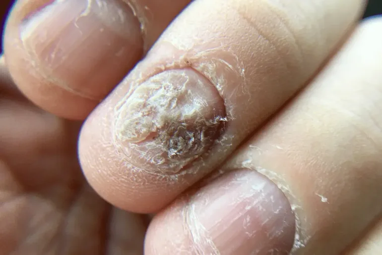 Does Nail Fungus Smell?