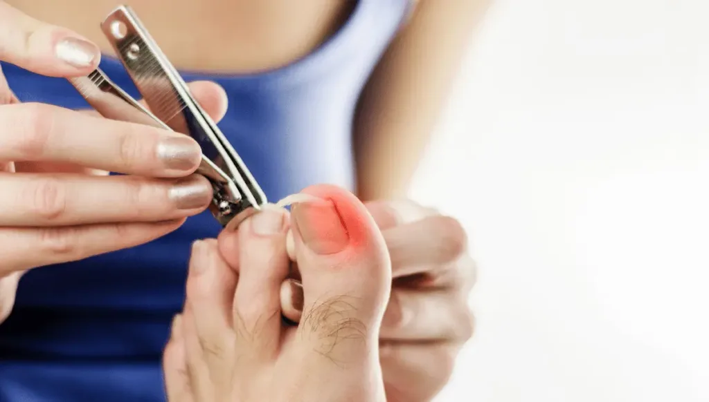 How to Treat Ingrown Toenail
