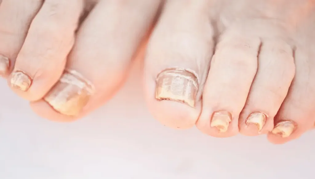 Prevention of Nail Fungus and Odor
